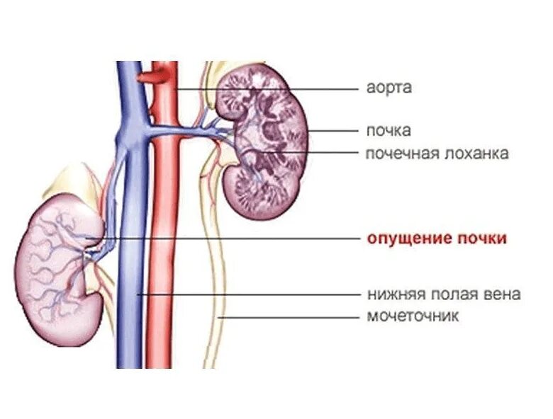 Боли в области мочеточника. Нефроптоз опущение почки. Нефроптоз почек 2 степени. Нефроптоз 1 степени правой. Опущение почки 1-2 степени лечение.