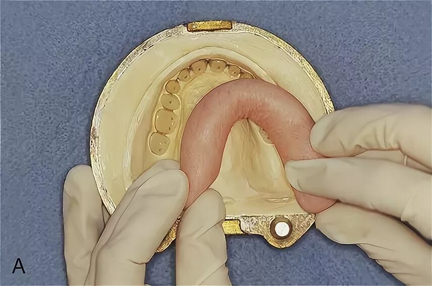 Паковка протеза в кювету. Формовка пластмассы в кювету. Стадии полимеризации пластмассы. Паковка пластмассы в кювету. Гипсовка протеза в кювету.