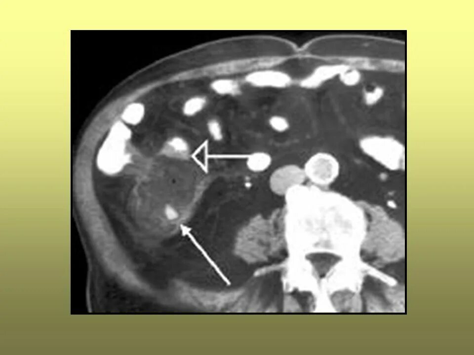 Аппендикулярный абсцесс кт. Аппендикулярный инфильтрат на кт. Холангиогенный абсцесс кт. Инфильтрат брюшной полости на кт. Наличие гноя в брюшной полости