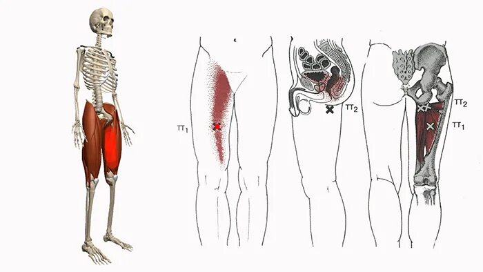 Боль в бедре диагноз. Триггерные точки портняжная мышца. Триггерные точки бедра. Триггерные точки прямой мышцы бедра. Приводящие мышцы бедра триггерные точки.