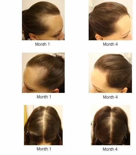 Рост волос после химиотерапии. Причёски для ускорения роста волос. Стрижки для роста волос. Стрижка по росту волос.
