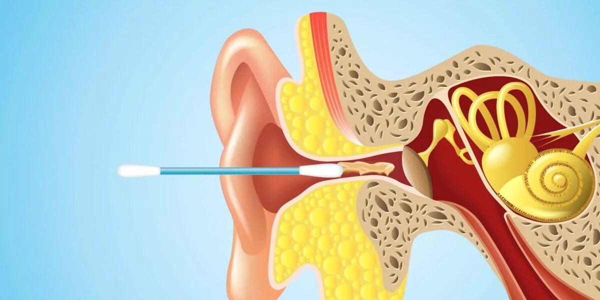 Clean ear. Серная пробка на барабанной перепонке. Анатомия уха серная пробка.