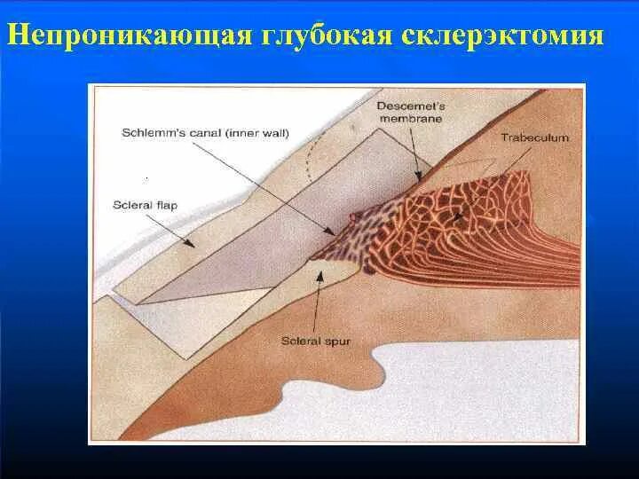 Непроникающая глубокая склерэктомия