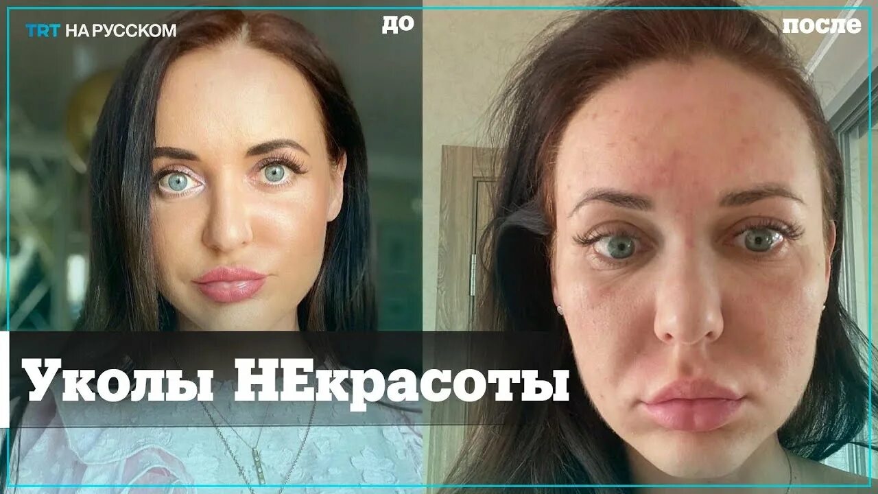 Ботокс эффект тианде. Биоревитализация монако. Уколы красоты в сентябре 2024. Монако биоревилитация. Уколы красоты в сентябре 2024.