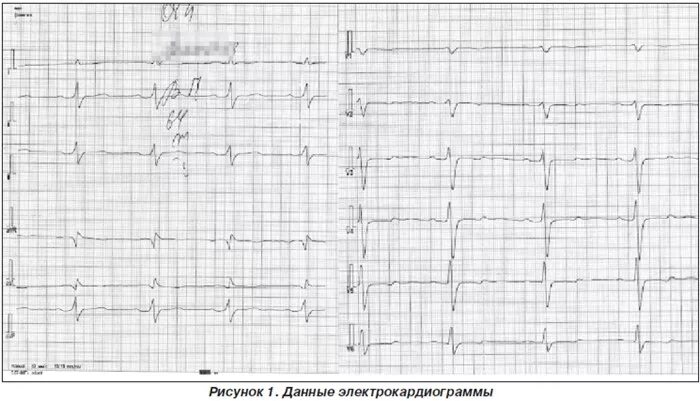 Ранняя реполяризация желудочков на ЭКГ. Синдром ранней реполяризации желудочков на ЭКГ. Синдром ранней реполяризации на ЭКГ. Нарушение процессов реполяризации в миокарде. Нарушение признаков реполяризации