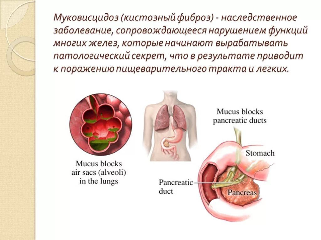 Муковисцидоз типы. Симптомы легочного муковисцидоза. муковисцидоз легочно кишечная форма. муковисцидоз кистозный фиброз.