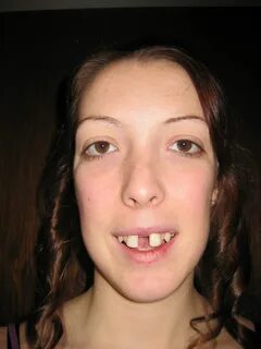 mskirby-sarpe / Facial and braces pics.