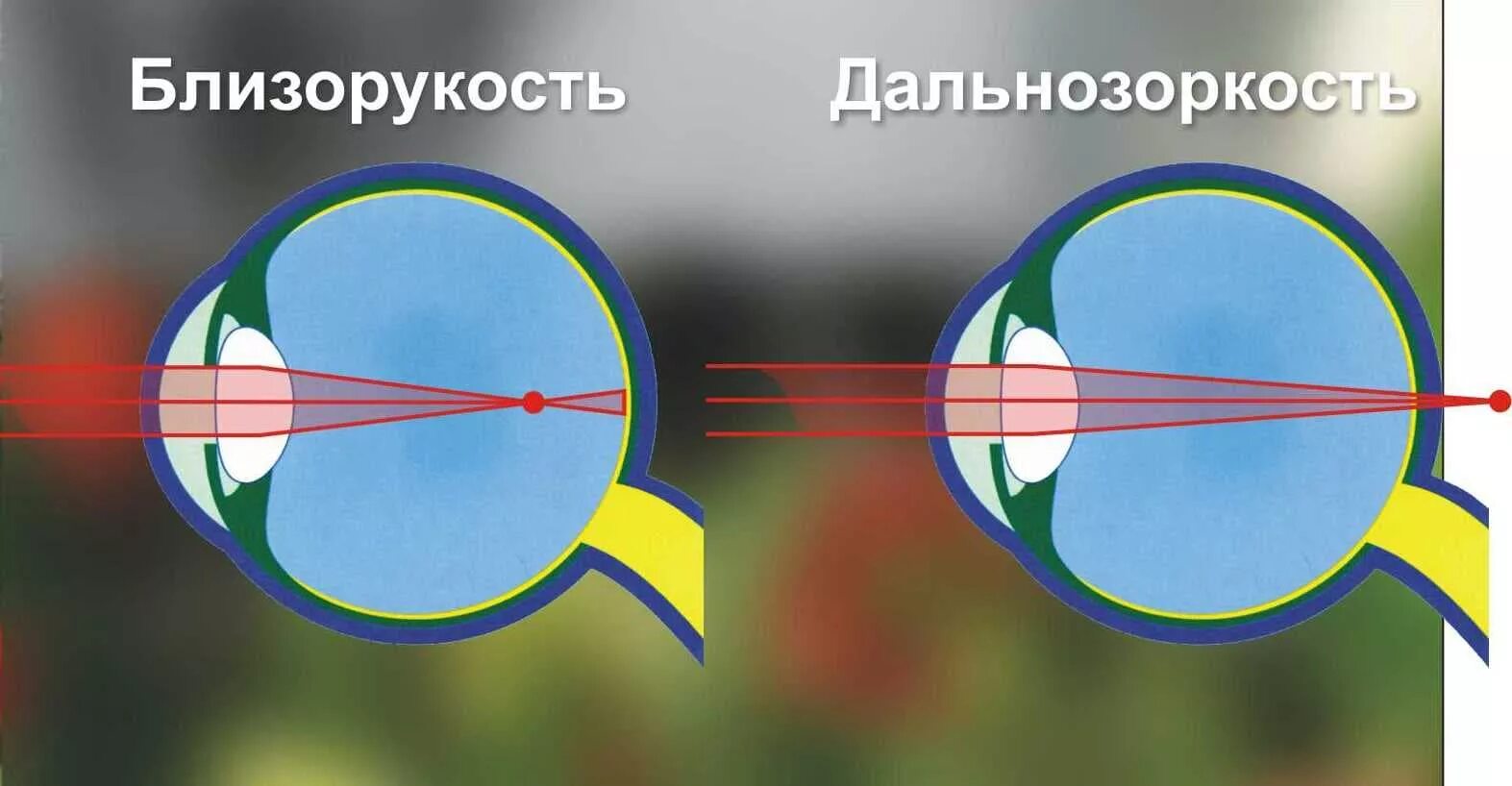 Миша страдает близорукостью а его брат дальнозоркостью. Дальнозоркость. Близорукость. Миопия и гиперметропия. Близорукости и дальнозоркости различия.