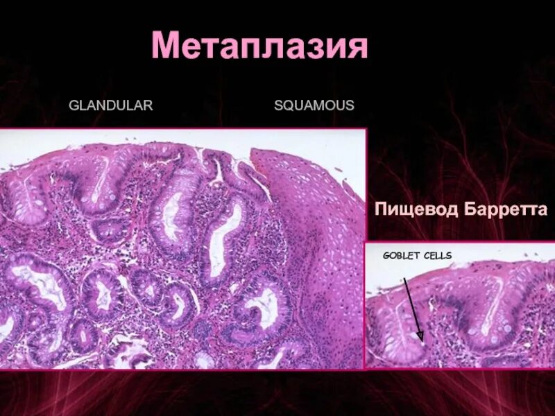 Кишечная метаплазия патанатомия. Желудочная цилиндроклеточная метаплазия пищевода. Метаплазия пищевода гистология. Желудочная метаплазия пищевода гистология.