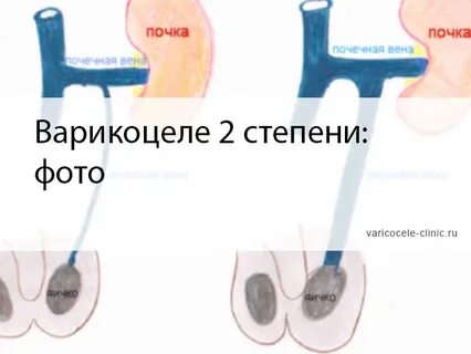 Варикоцеле 2 степени
