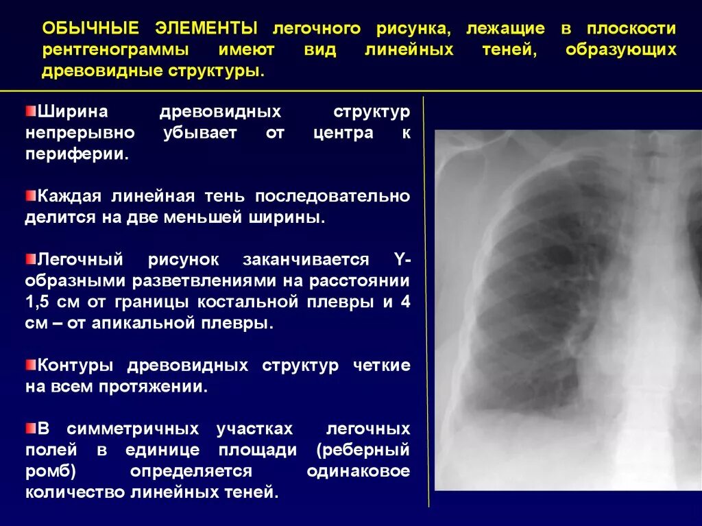 Легочный рисунок. Легочной рисунок в норме на рентгене. Нормальный легочный рисунок. Элементы легочного рисунка. Анализ легочного рисунка.