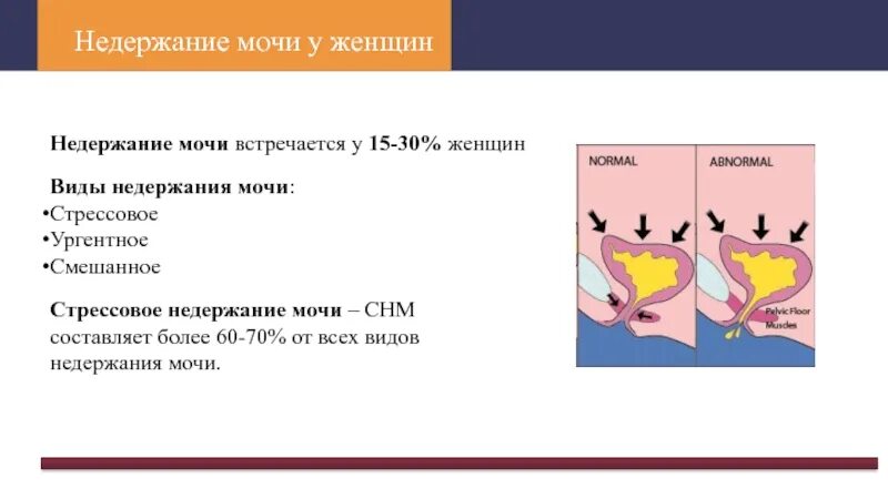 Какие причины недержания мочи. Ургентное недержание. недержание мочи у женщин. стрессовое и ургентное недержание мочи. стрессовое недержание мочи у женщин.