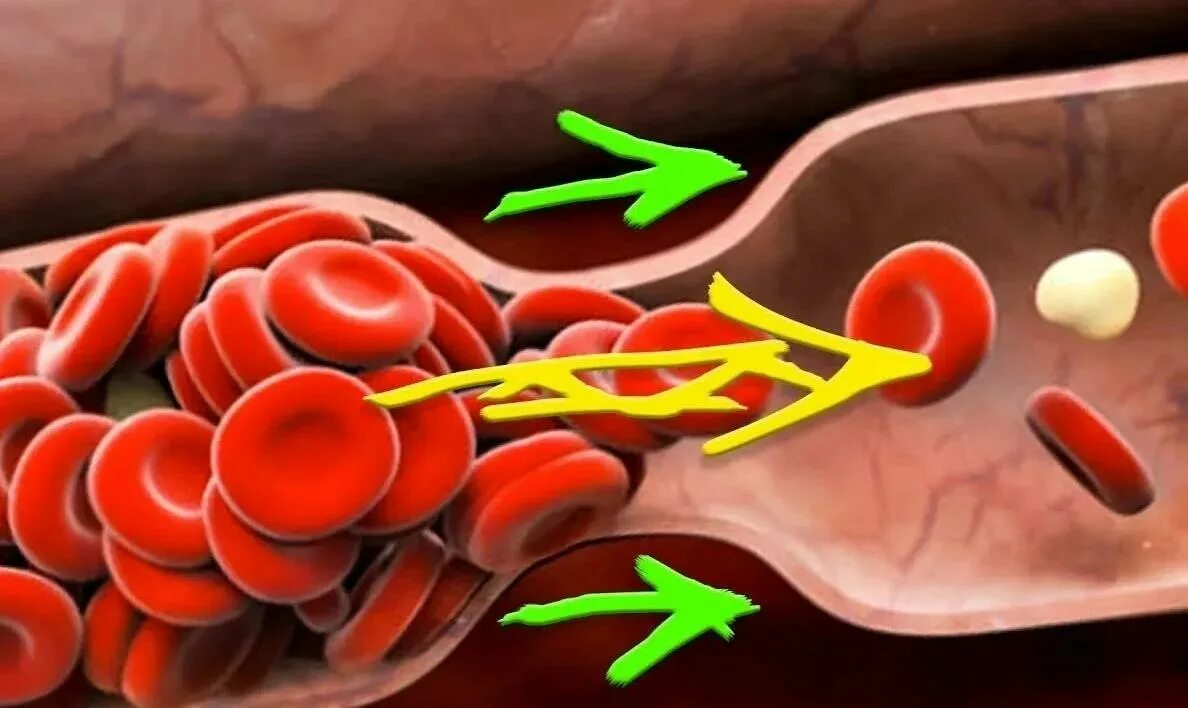 Густая кровь что принимать. Профилактика атеросклероза. Для разжижения крови. Тромбообразование в сосуде.