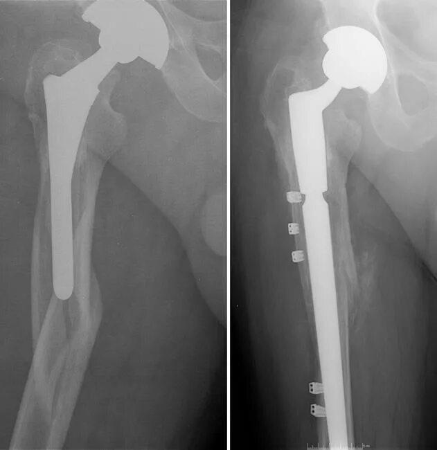 Тазобедренный сустав операция фото. Перелом шейки бедра эндопротезирование тазобедренного сустава. Перипротезный перелом тазобедренного сустава. Перелом бедра после эндопротезирования тазобедренного сустава. Ревизия ТБС эндопротеза.