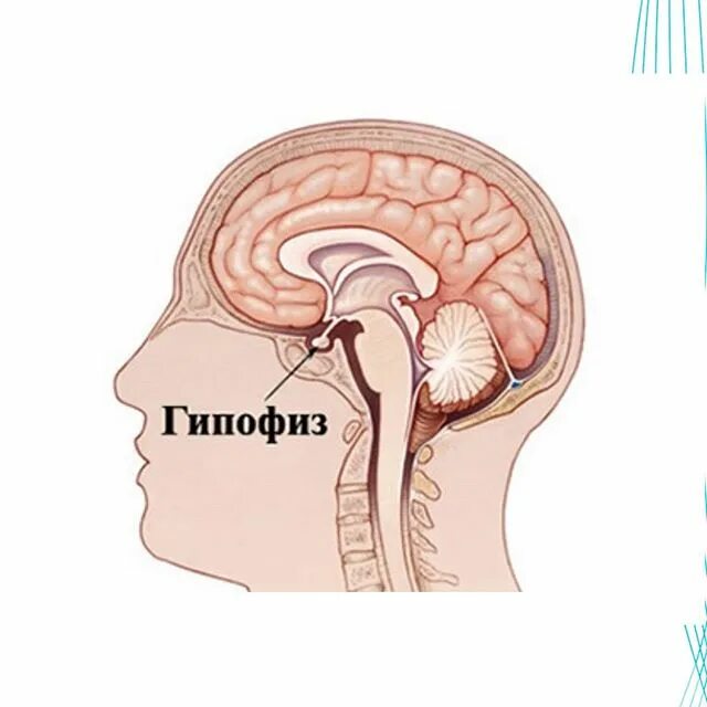 Аденома гипофиза акромегалия. Гипофиз головного мозга. Аденома гипофиза внешность. Опухоль гипофиза пролактинома.