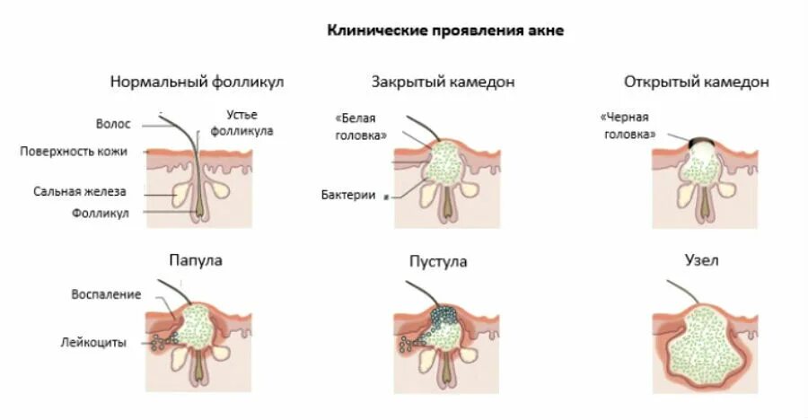 Кожные узлы. Воспалительные узлы акне.