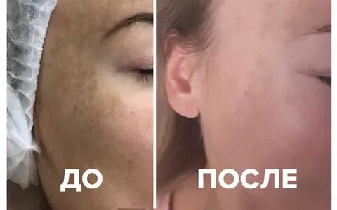 Мезотерапия от пятен