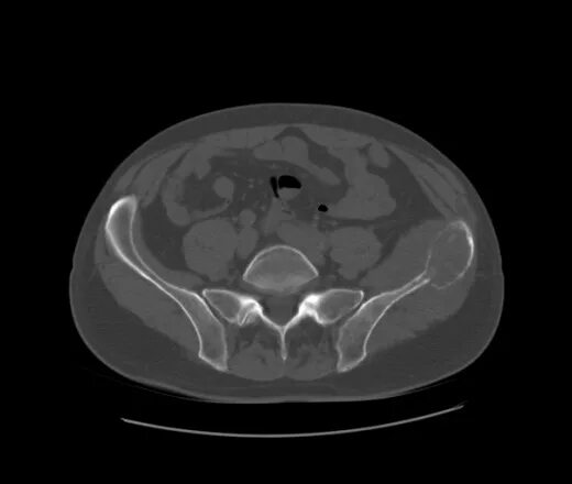 Кт подвздошной кости. Остеосаркома подвздошной кости на кт. Литические очаги в подвздошной кости кт. Аневризмальная киста подвздошной кости кт. Аневризматическая киста бедренной кости на кт.