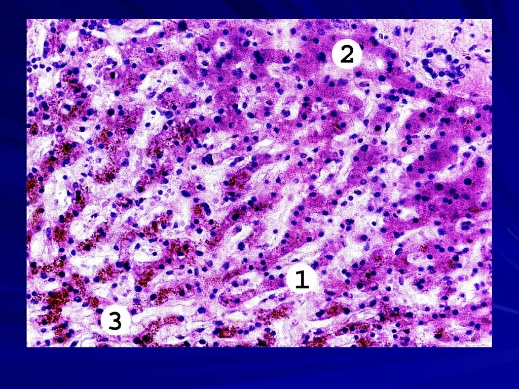 Печень микропрепарат описание. Гидропическая дистрофия гепатоцитов гистология. Гидропическая дистрофия печени гистология. Бурая атрофия печени макропрепарат. Бурая атрофия печени патанатомия.