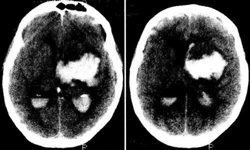 Внутримозговое кровоизлияние кт. Геморрагический инсульт кт. Внутрижелудочковое кровоизлияние кт. Кровоизлияние в желудочки