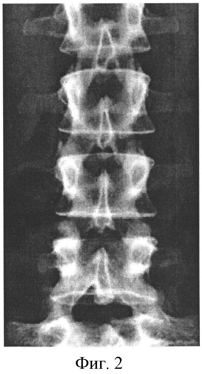 Рентгенография позвоночника в 2 х проекциях. Рентген крестцово-поясничного отдела рентген. Рентгенограмма крестцового отдела позвоночника. Рентген поясничного отдела позвоночника норма и патология. Рентген позвоночно крестцового отдела.