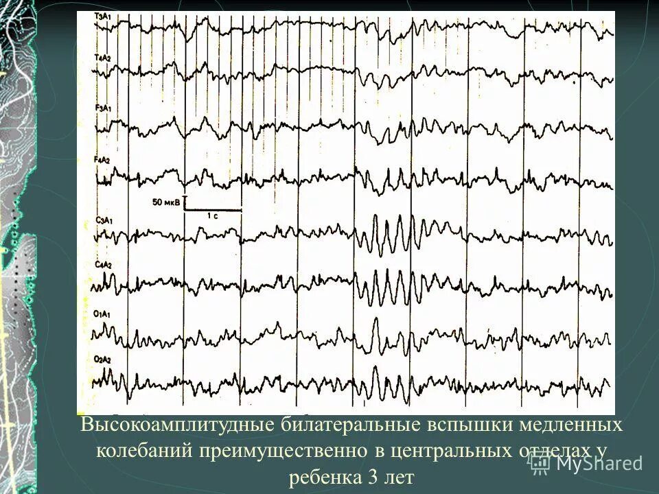 Медленные волны на ээг. Вспышки бета волн на ЭЭГ. Билатерально-синхронные вспышки что это. Вспышки высокоамплитудного бета ритма на ЭЭГ. Вспышки медленных волн на ЭЭГ.