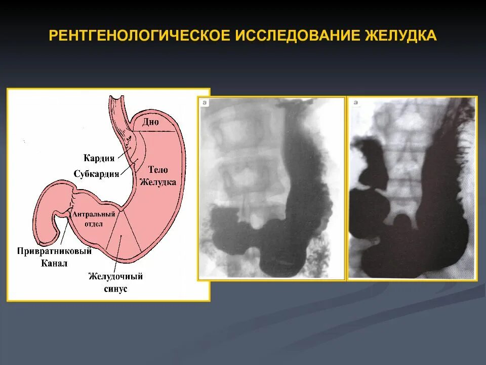 Рентгенологическое исследование пищевода, желудка, 12-перстной кишки.. Пенетрирующая язва желудка рентген. Рентгенконтрастное исследование с ва желуда. Язвенная болезнь кишечника рентген. Язва кт