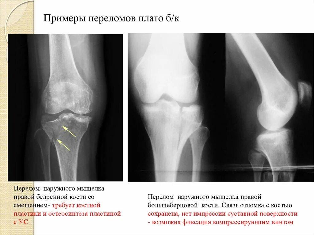 Внутрисуставной перелом мыщелка. Медиальный мыщелок большеберцовой кости перелом. Перелом наружного мыщелка большеберцовой кости рентген. Внутрисуставной чрезмыщелковый перелом большеберцовой кости. Трещина медиального мыщелка большеберцовой кости.