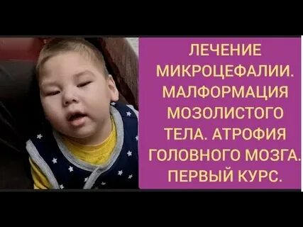 Симптомы микроцефалии у детей