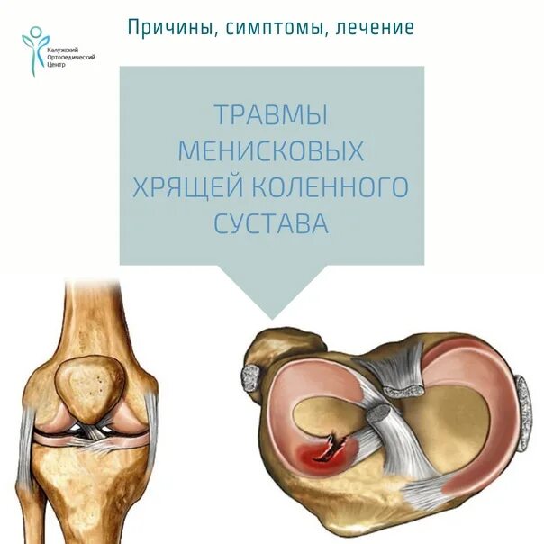 Менископатия коленного. Разрывы менисков коленного сустава. Повреждение хряща коленного сустава. Хрящ коленного сустава и мениск. Структурные изменения мениска