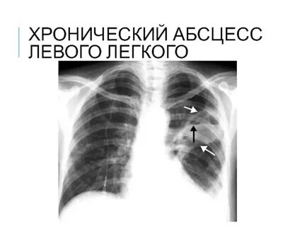 Хронический легких