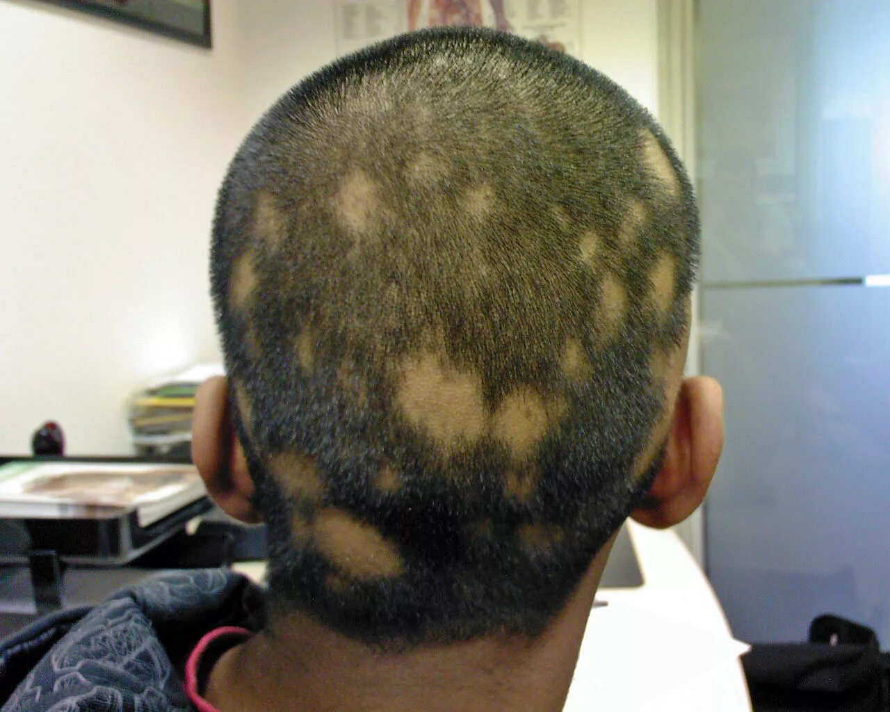 Выпадение волос у мужчин лечение. Экозависимая алопеция. Гнёздная (очаговая алопеция). Очаговая алопеция лысины?. Очаговая алопеция (alopecia Areata).