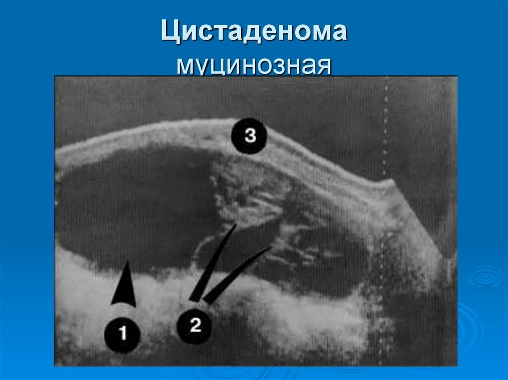 Папиллярная серозная цистаденома яичника. Серозная папиллярная цистаденома УЗИ. Опухолевидные образования яичников. Цистаденомы яичников на УЗИ. Образование женских половых органов