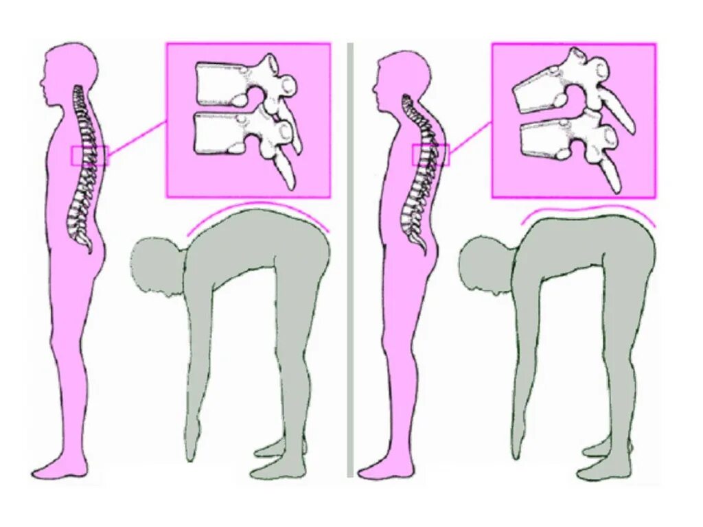 Выгнутая поясница. Кифоз грудного отдела позвоночника. Кифоз пояснично крестцового отдела. Искривление позвоночника синдром Шейермана МАУ. Кифоз грудного и поясничного отдела позвоночника.