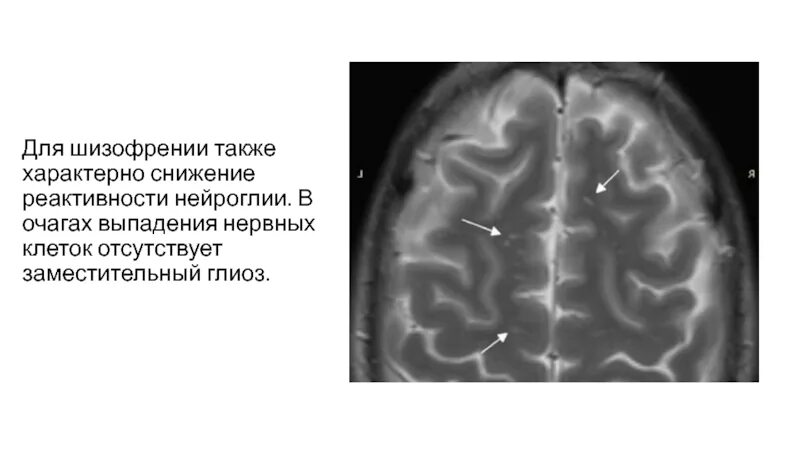 Единичный очаг в правой лобной доле. Кортикальный глиоз. Глиоз лобной доли. Лакунарный глиоз. Очаги глиоза.