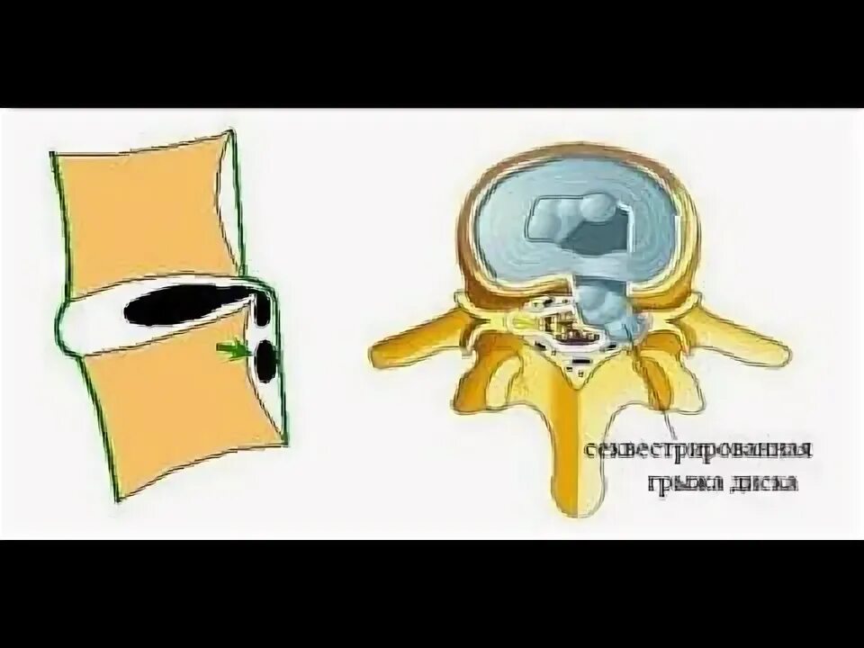 Как лечить грыжа диска без операции. Секвестр межпозвонкового диска. секвестр грыжа позвоночника поясничного отдела. секвестрированная экструзия l5-s1 диска. секвестрация грыжи межпозвоночного диска что это такое.