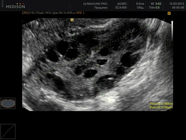 Синдром поликистоза яичников на УЗИ. УЗИ яичников норма и поликистоз. Ультразвуковая картина поликистоз яичников. Мультифолликулярные яичники на УЗИ.