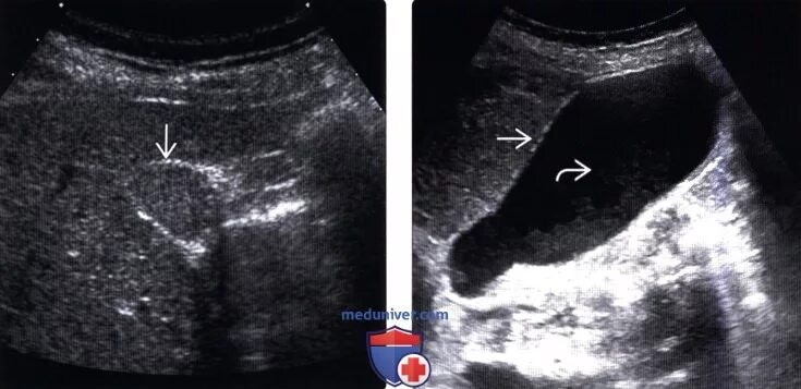 Эхогенный желчный пузырь. Сладж-синдром желчного пузыря.