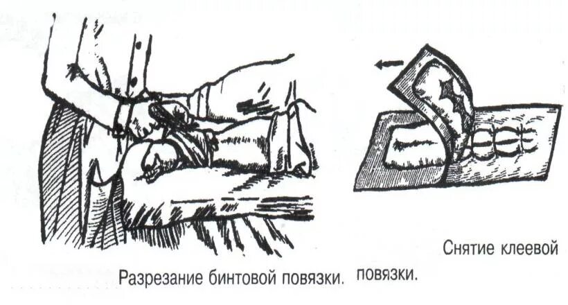 Инструментальная перевязка. Алгоритм перевязки чистой раны после операции. Техника инструментальной перевязки раны.. Техника перевязки гнойных РАН. Повязка гнойной раны алгоритм.