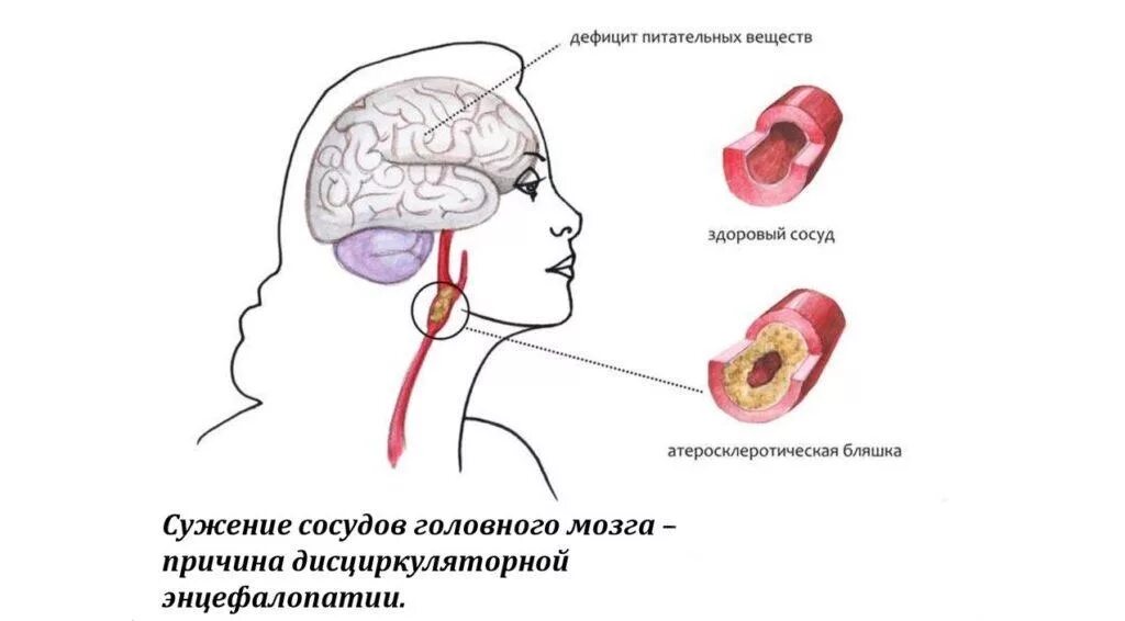 Энцефалопатия симптомы. Дисциркуляторная энцефалопатия.