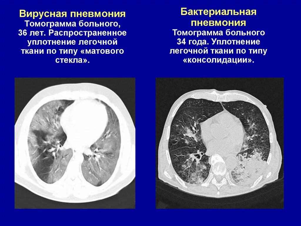 Бактериальная пневмония на кт легких. Вирусно-бактериальная пневмония кт. Пневмония кт матовое стекло. Вирусная пневмония на кт легких.