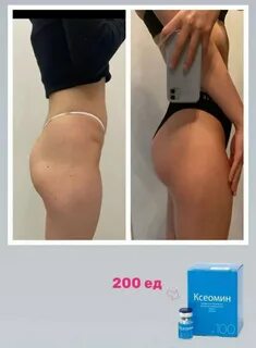 Операция по увеличению ягодиц