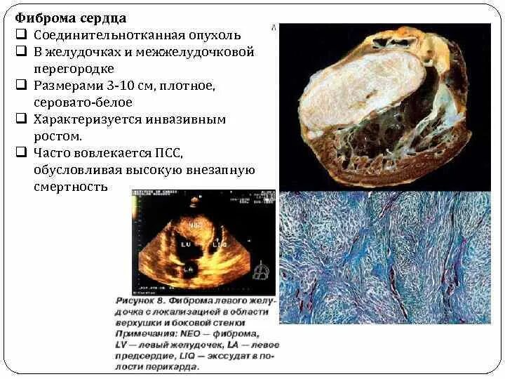 Рабдомиома сердца. Папиллярная фиброэластома сердца. Множественная рабдомиома сердца.