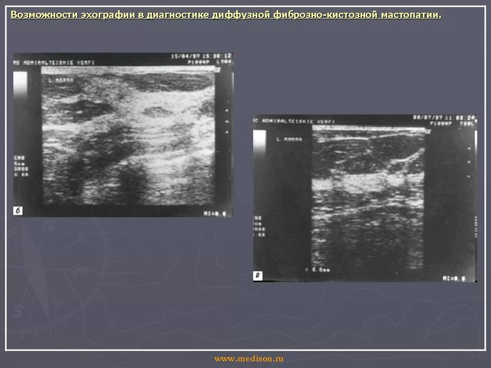 Фиброзно-кистозная мастопатия молочных желез на УЗИ. Диффузная фиброзно-кистозная мастопатия молочных желез на УЗИ. Фиброзная мастопатия УЗИ. Фиброзно кистозная мастопатия молочной железы УЗИ. Диффузно фиброзно кистозная изменения