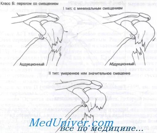 Перелом шейки плеча у пожилых. Аддукционный перелом хирургической шейки. оскольчатый перелом хирургической шейки. абдукционный перелом хирургической шейки. аддукционный перелом хирургической шейки плеча рентген.