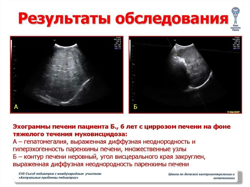 Изменения печени у ребенка. Диффузные изменения паренхимы печени. Диффузное поражение печени УЗИ. Диффузионные изменения паренхимы печени. Диффузные изменения паренхимы печени на УЗИ.