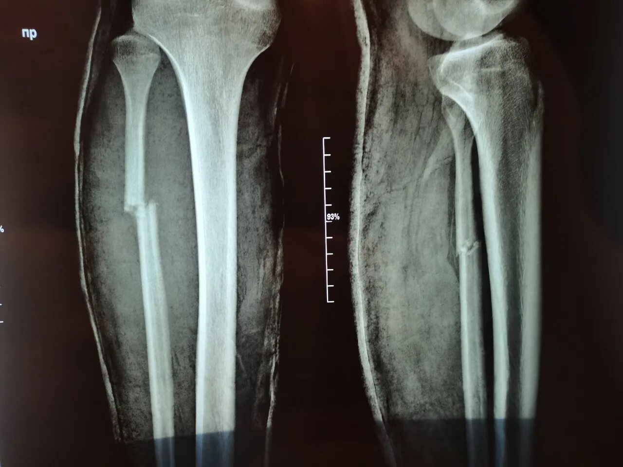 Перелом малой берцовой кости. Перелом н3 малой берцовой кости. Перелом малой берцовой кости со смещением рентген. Перелом малый малый берцовой кости.
