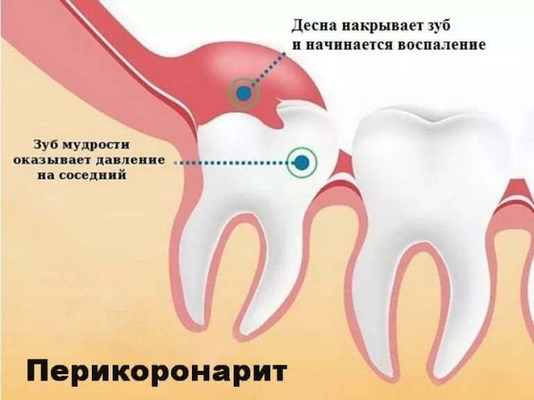 Удаление зуба мудрости под. Перикоронит зубов мудрости. прорезывание зуба мудрости. прорезается зуб мудрости.