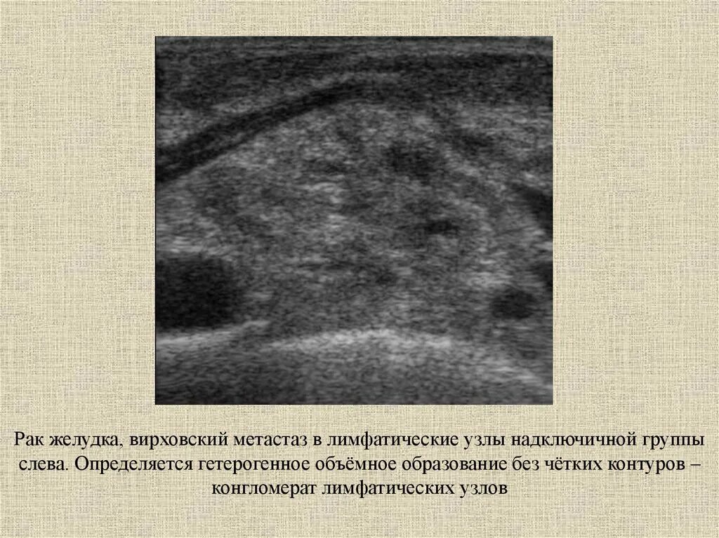 Метастазы лимфоузлы форум. Конгломерат лимфатических узлов на УЗИ. Конгломерат лимфоузлов на УЗИ. УЗИ заушных лимфатических узлов.