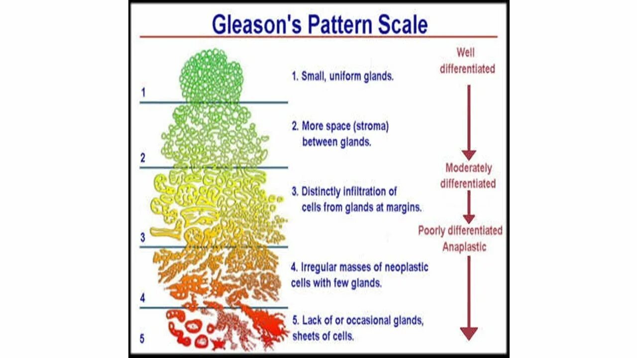 Глисон простата. Шкала Глисона. Глисон классификация. Классификация Глиссона. Gleason классификация.